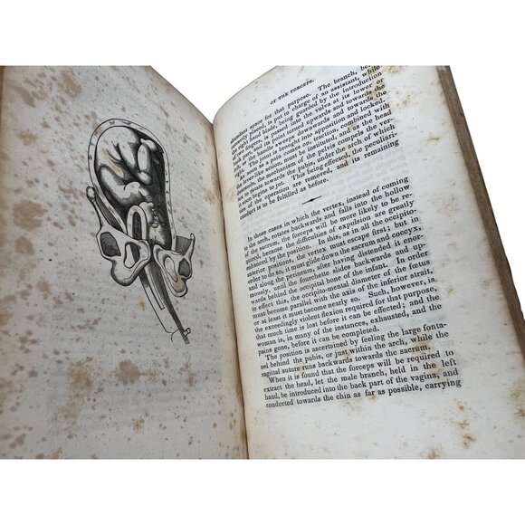 1838 The Philadelphia Practice of Midwifery Charles D Meigs First Ed Illustrated - Picture 9 of 12